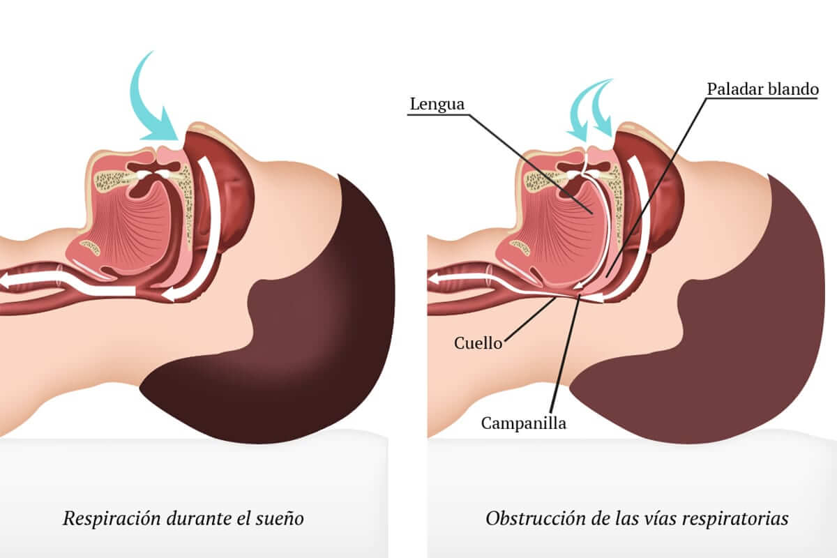 Qué es la Apnea del sueño Clínica Birbe