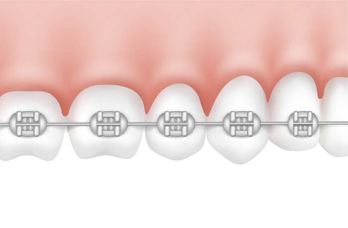 ¿Cómo funcionan los brackets de ortodoncia?