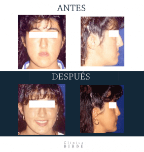 Cambios en la nariz de la cirugía ortognática: ¿cómo controlarlos?