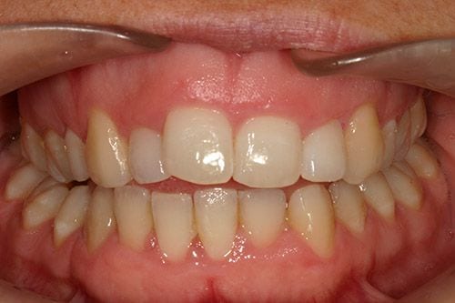 Antes sonrisa gingival