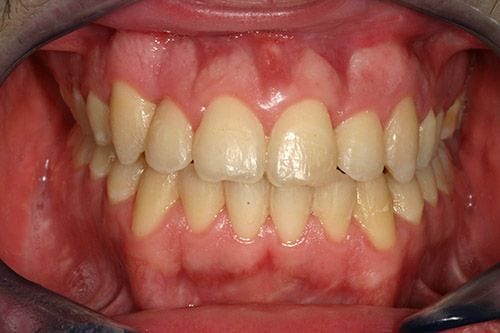 Mordida abierta con Invisalign