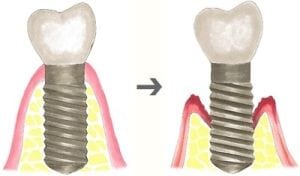 periimplantitis