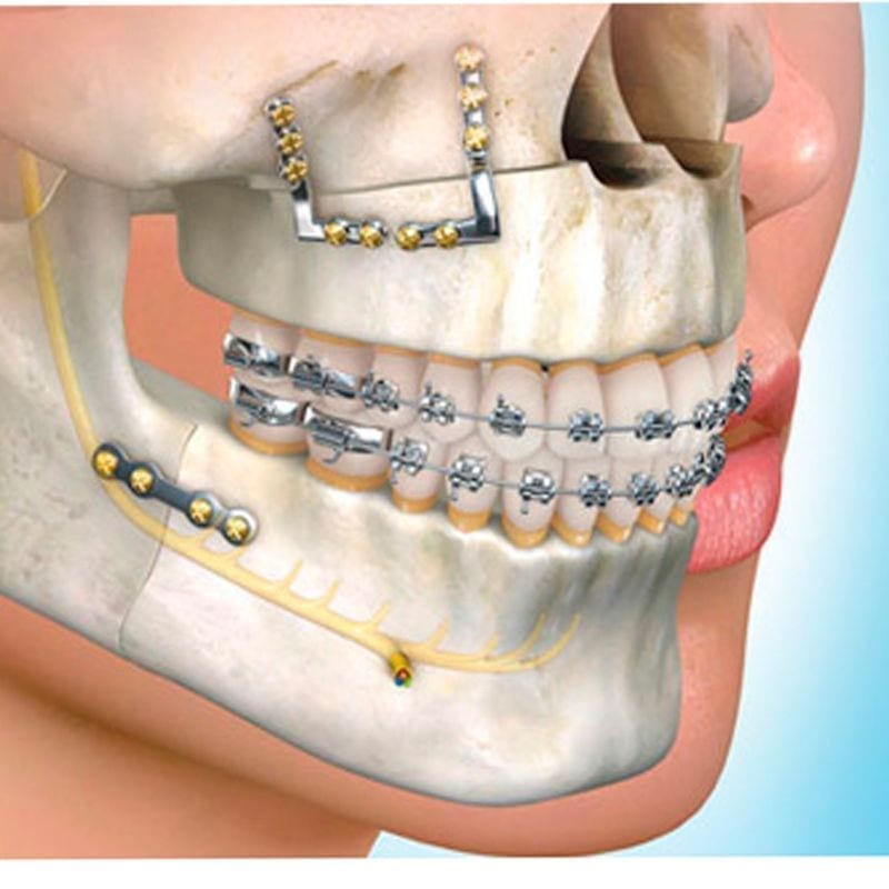 Solución maxilofacial