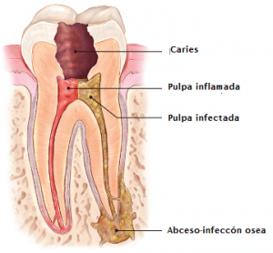 endodoncia barcelona