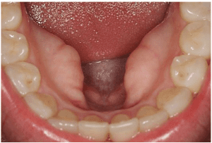 ¿Qué son los torus mandibulares?