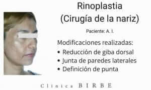 Modificaciones paciente rinoplastia