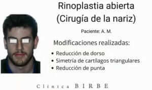 Paciente de rinoplastia abierta