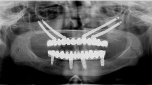 Zygomatic Implants