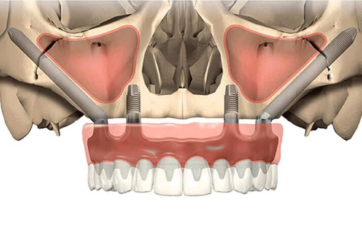 Implantes cigomáticos en Barcelona