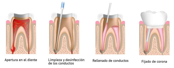 Tratamiento endodoncia