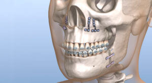 Orthofacial Surgery