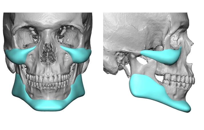 Implantes faciales en Barcelona