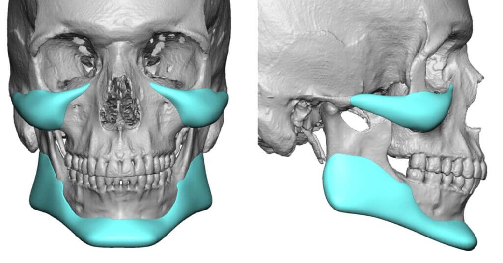 Implantes faciales en Barcelona