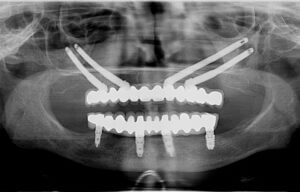 Implantes cigomáticos