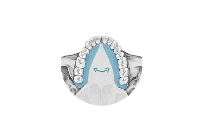 Paladar estrecho con Invisalign