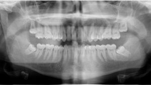 Tratamiento de dientes incluidos y cordales - Clínica Birbe