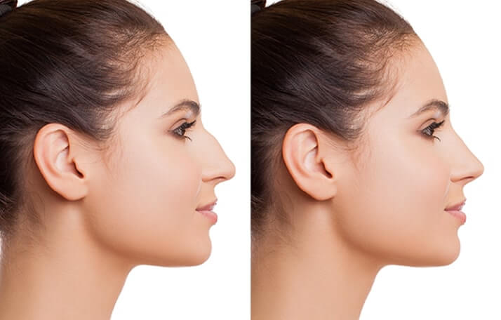 rinoplastia
