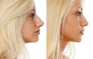 Rhinoplasty in Spain vs. Turkey: Why Choosing Clínica Birbe in Spain Means Superior Quality, Safety, and Patient Care