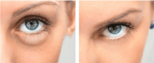 Blefaroplastia párpado inferior en Barcelona