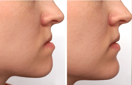 Cirugía ortognática en Barcelona