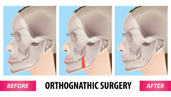 Prognatismo mandibular antes y después