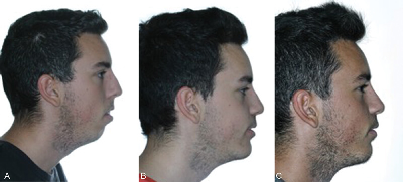 tecnica reducir dorso nasal cirugía ortognática