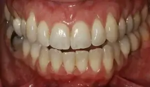 Periodoncia antes