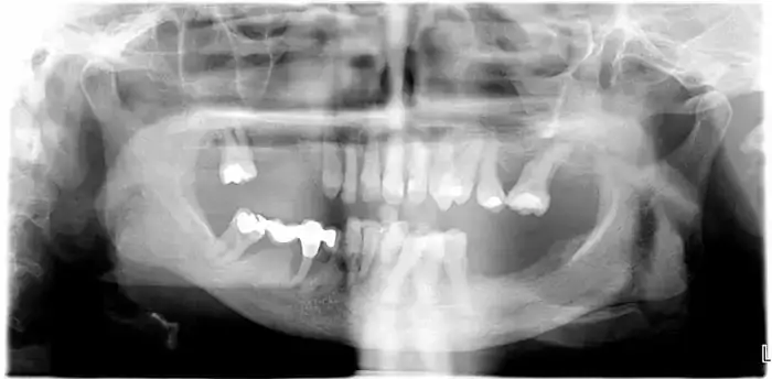 Antes de los implantes cigomáticos