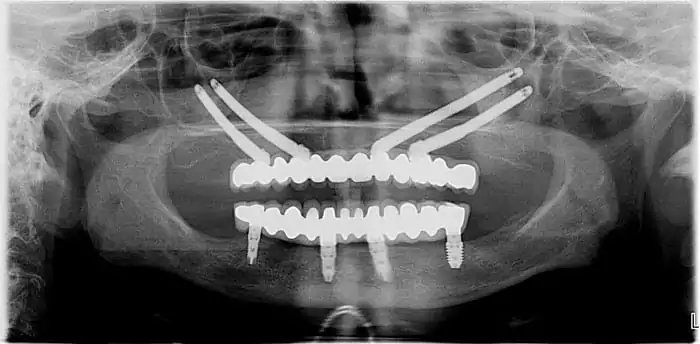 Después de los implantes cigomáticos