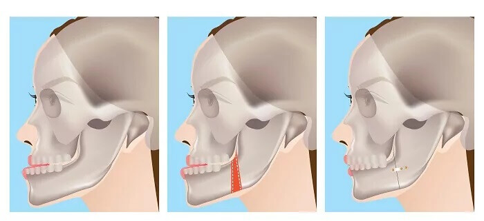 Prognatismo mandibular en Barcelona