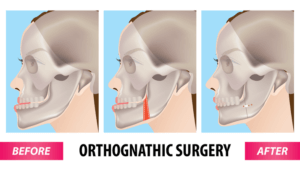 cirugia ortognatica