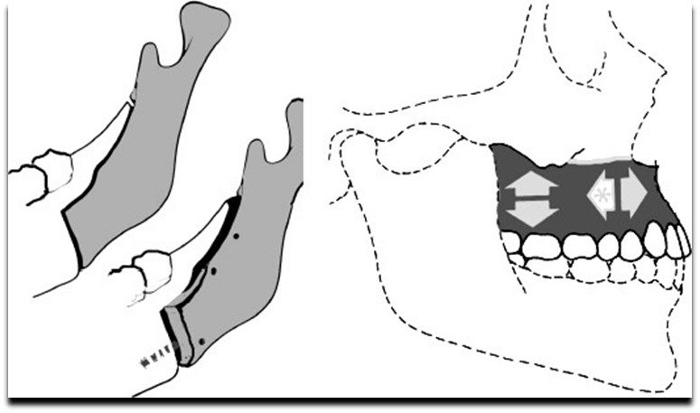 Orthognathic and facial plastic surgery in Barcelona