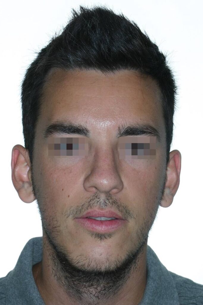 caso mordida abierta