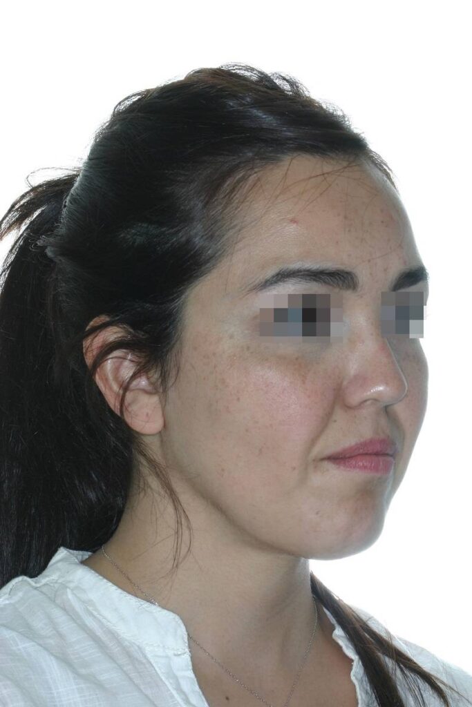 Caso clínico lifting profundo facial
