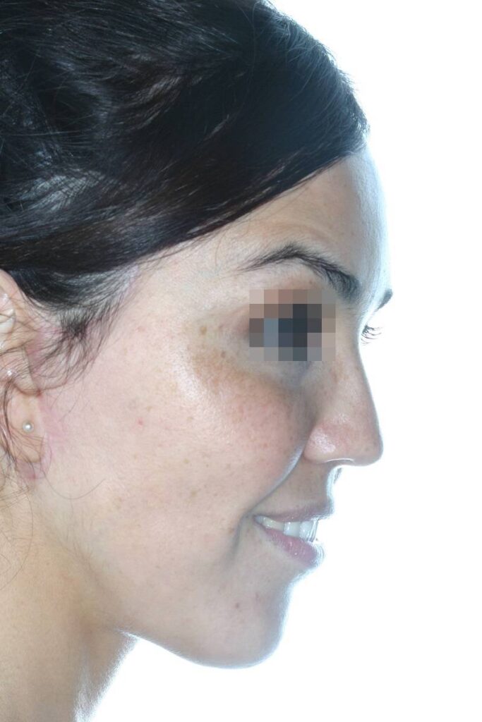 Caso clínico lifting profundo facial