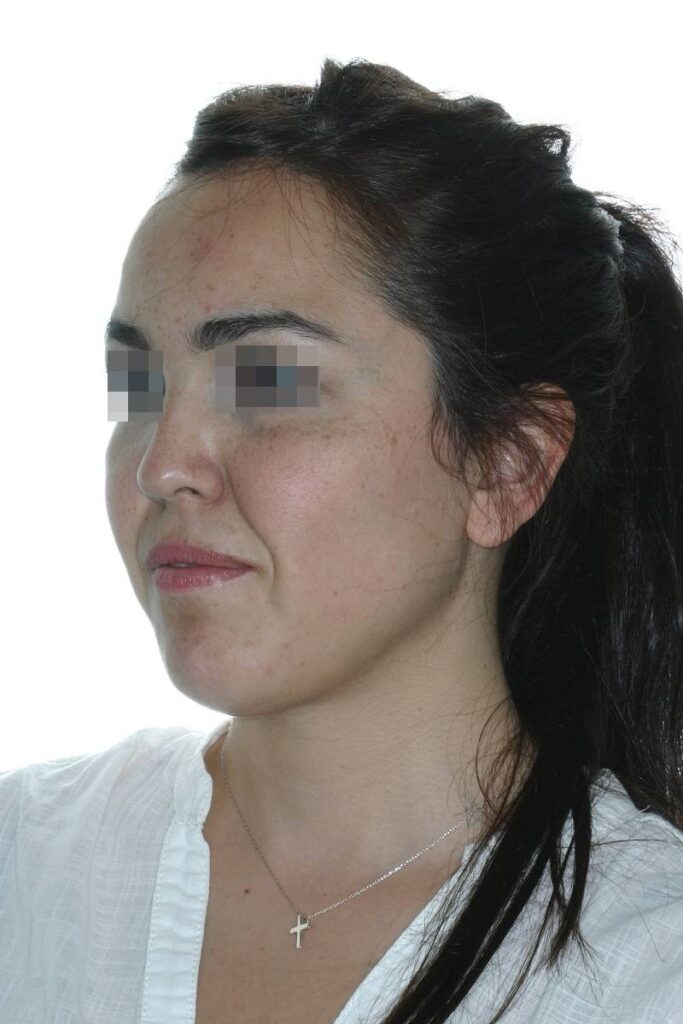 Caso clínico lifting profundo facial