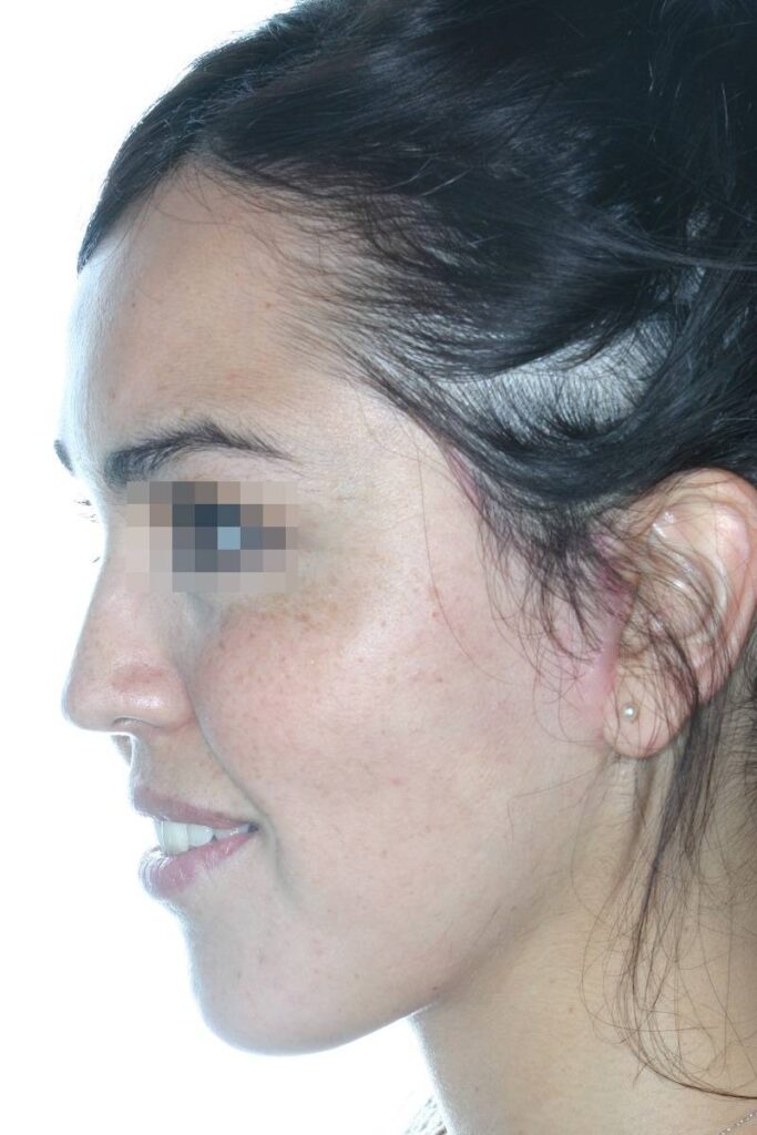Caso clínico lifting profundo facial