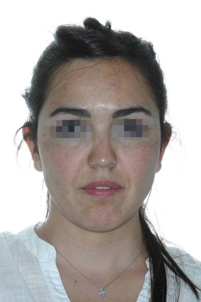 Caso clínico lifting profundo facial