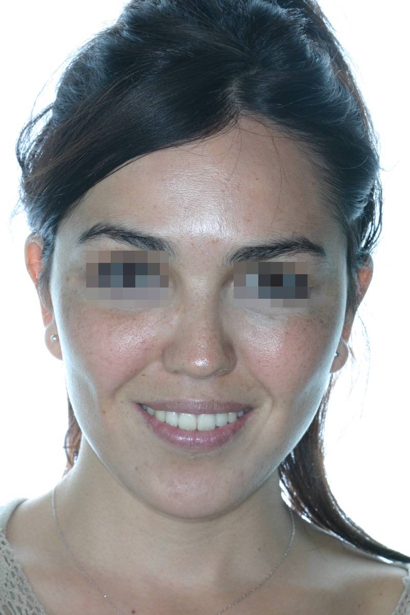 Casos clinicos lifting Facial