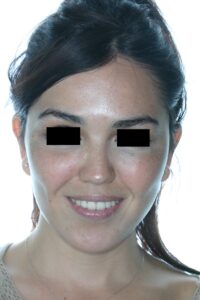 Caso clínico lifting profundo facial