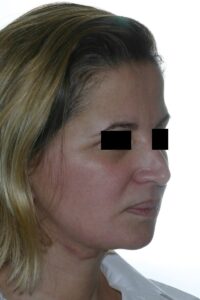 Caso clínico lifting de cara, cuello, blefaroplastia y lifting de cejas