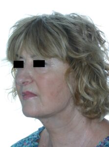 Caso clínico lifting profundo de cuello y cara, con reducción de glándula submaxilar y de músculos digástricos