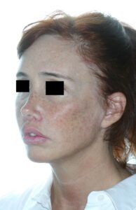 Caso clínico lip lift, lifting de cejas i lipofilling de zona infraorbitaria