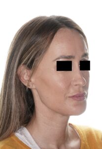 mentoplastia de retroceso