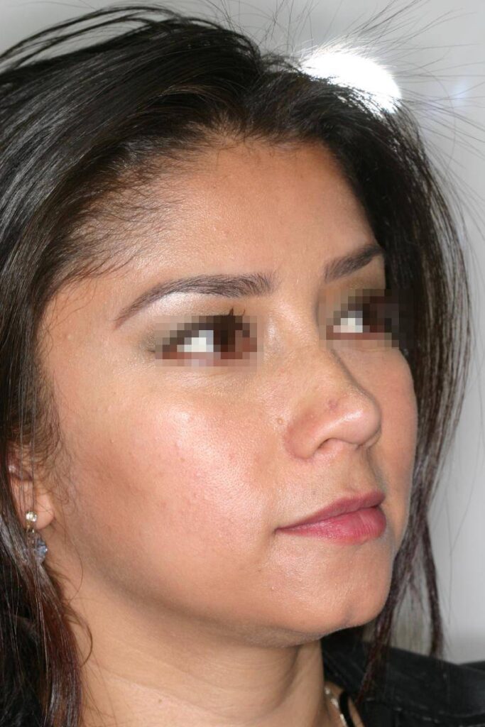 Caso Clínico Rinoplastia