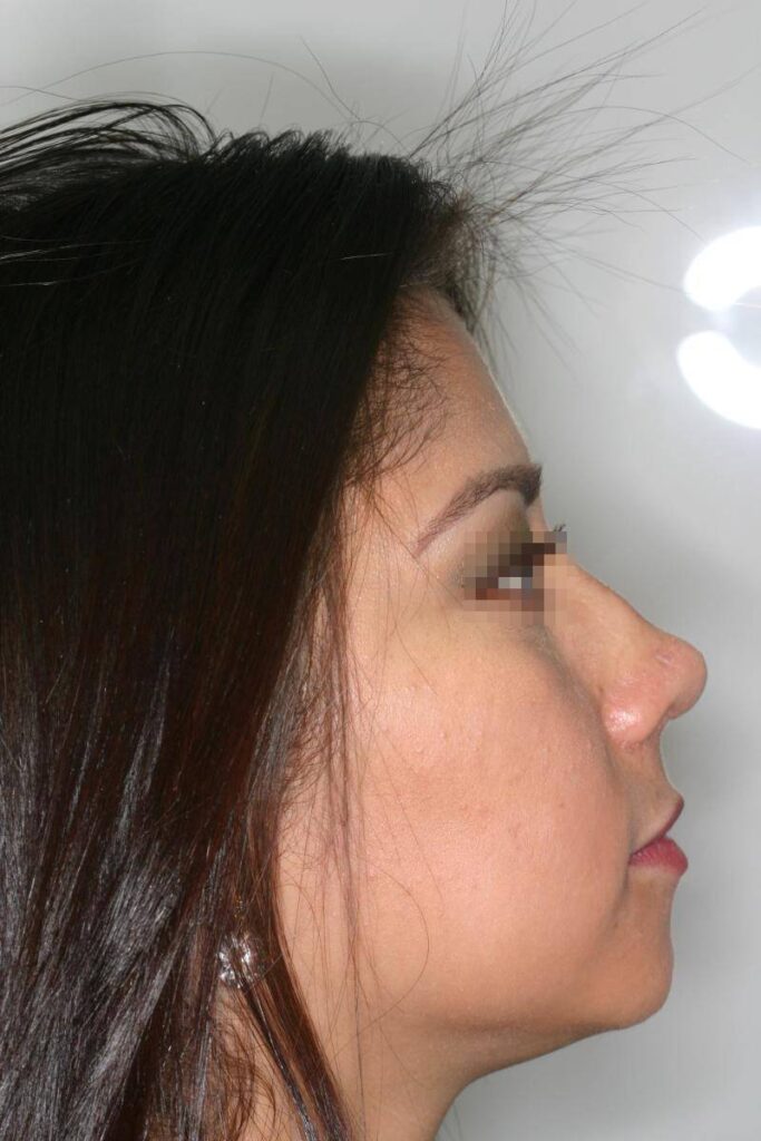 Caso Clínico Rinoplastia