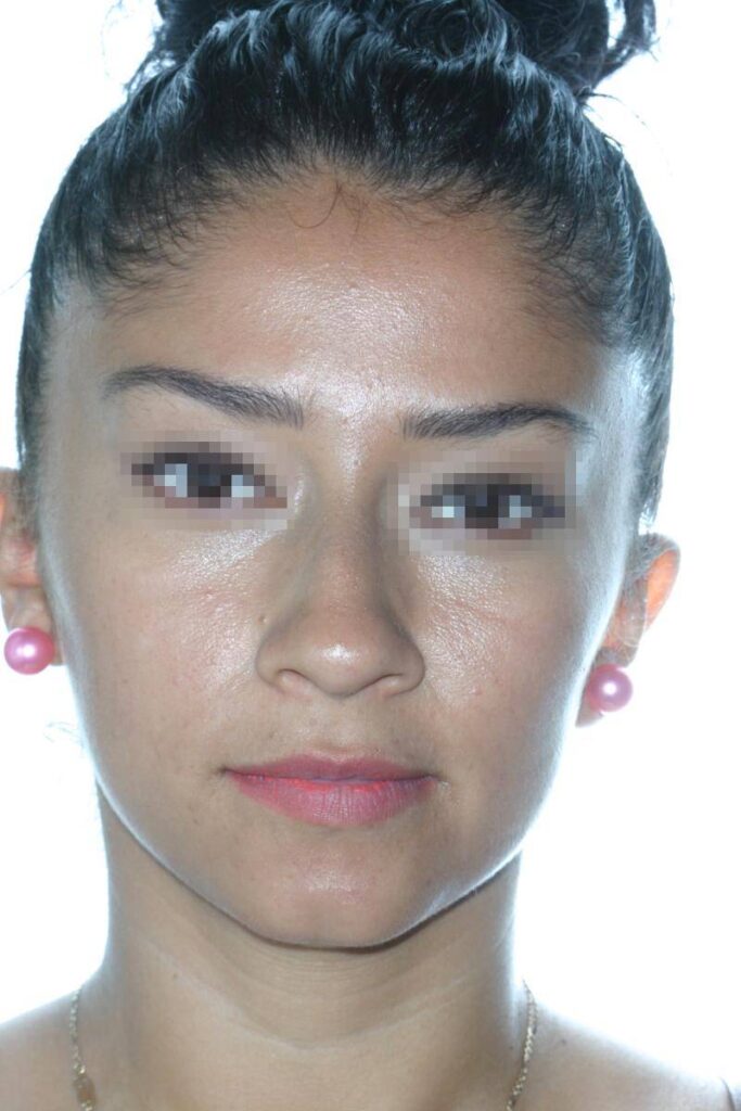 Caso Clínico Rinoplastia