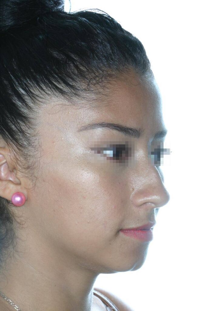 Caso Clínico Rinoplastia