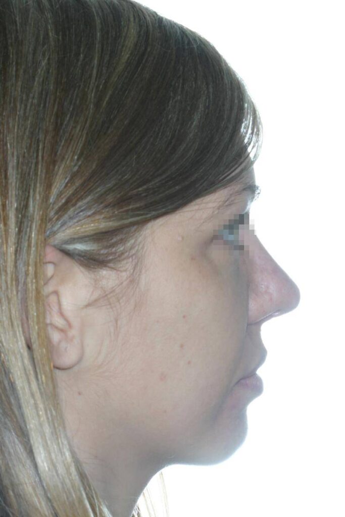 Caso Clínico Rinoplastia