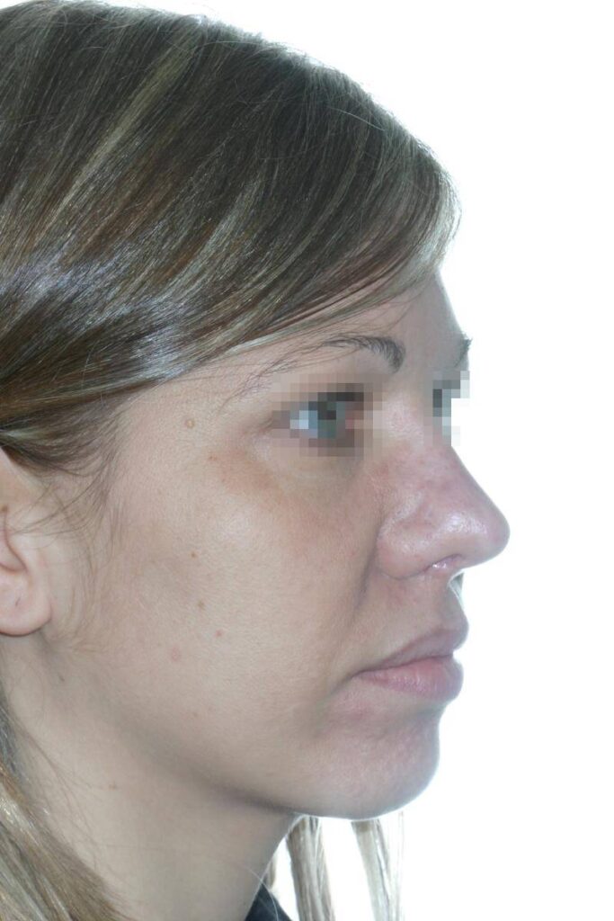 Caso Clínico Rinoplastia